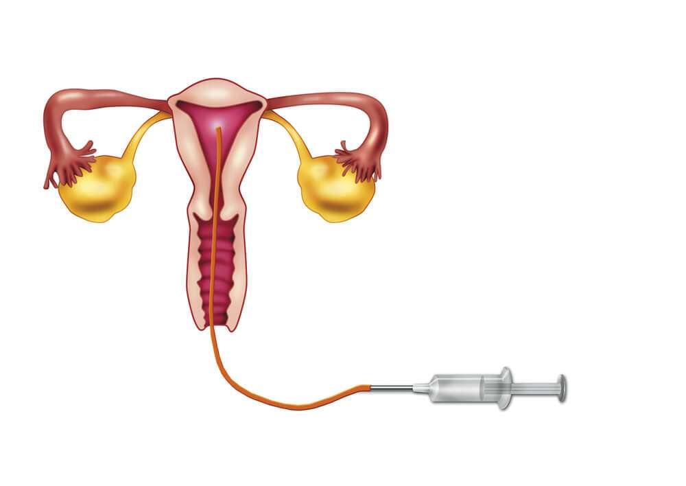 Descubra as diferenças entre FIV e inseminação intrauterina