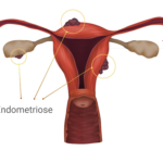 Útero com focos de endometriose