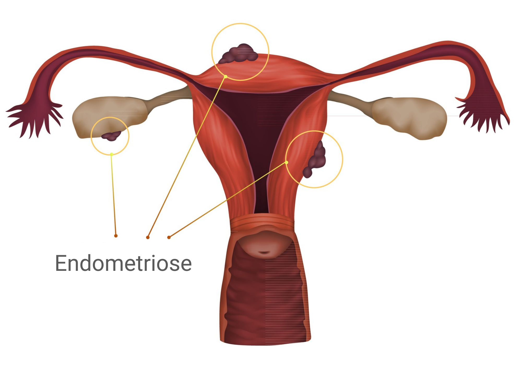Descobrindo o poder das mulheres na luta contra endometriose e cânceres