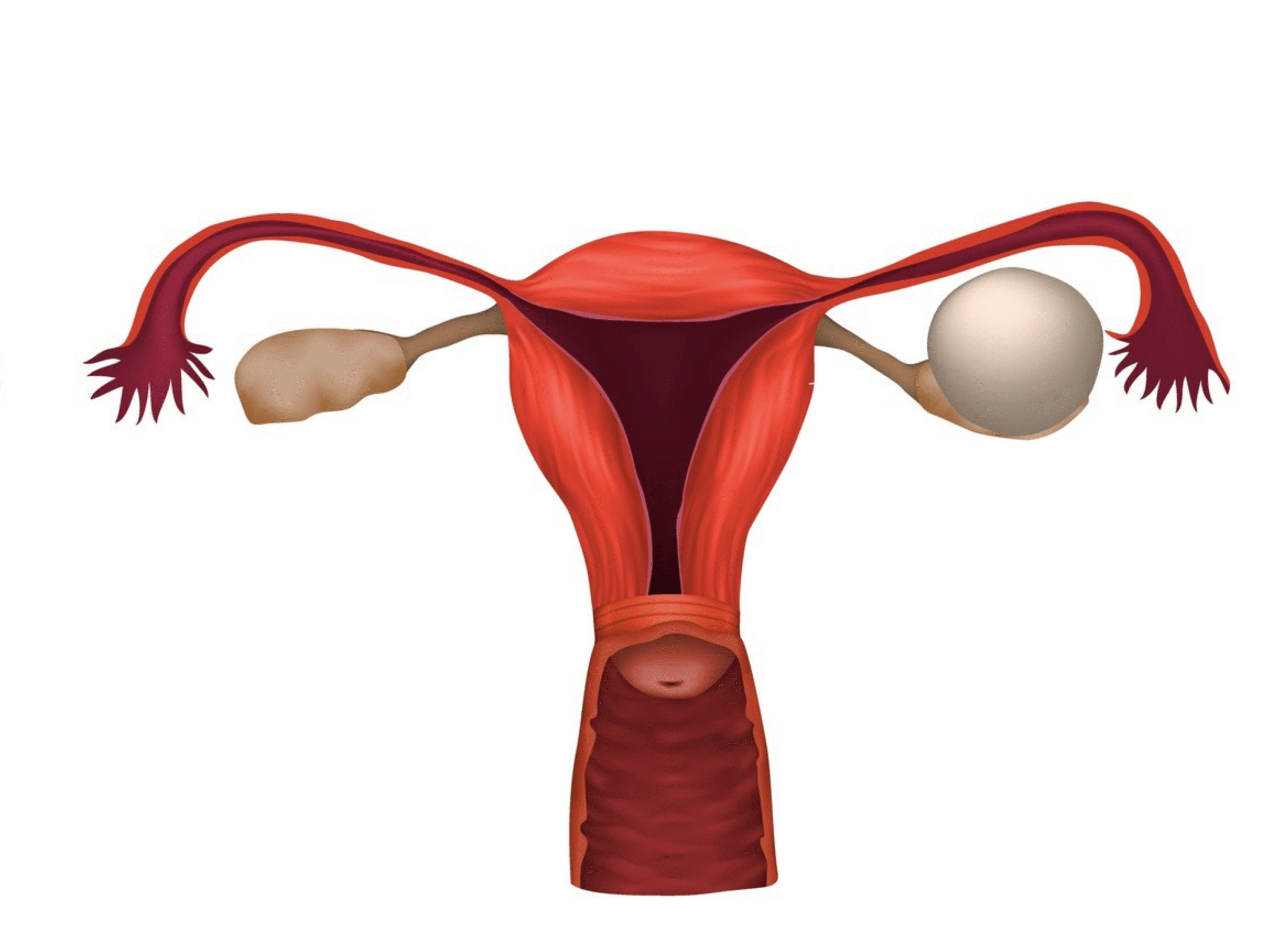Cisto hemorrágico fertilidade feminina